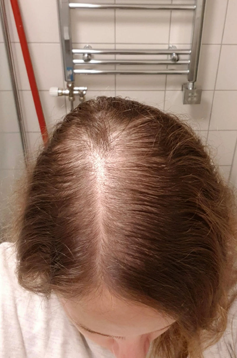 Kirkland Minoxidil 5% - Hairloss treatment - Hairdealz.com