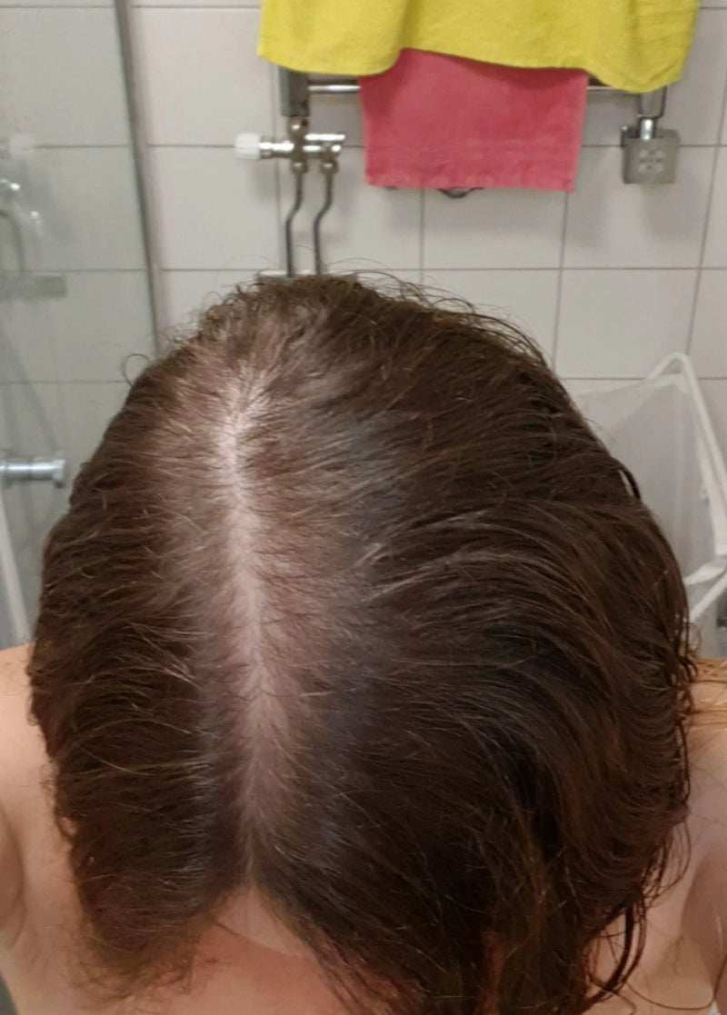 Kirkland Minoxidil 5% - Hairloss treatment - Hairdealz.com