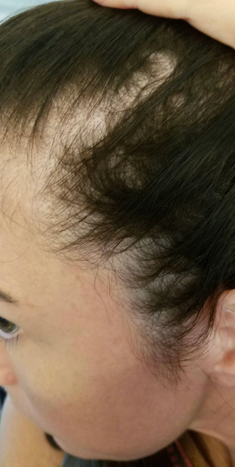 Kirkland Minoxidil 5% - Hairloss treatment - Hairdealz.com