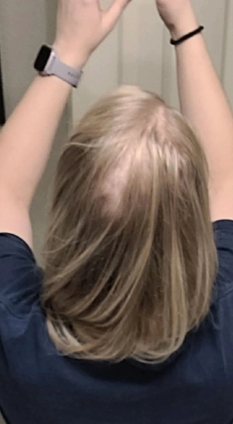 Kirkland Minoxidil 5% - Hairloss treatment - Hairdealz.com