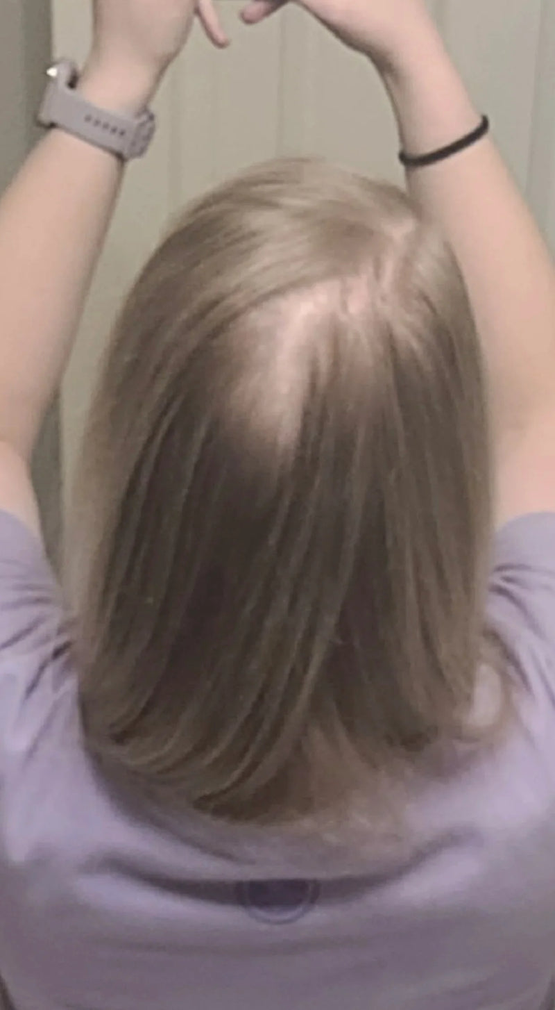 Kirkland Minoxidil 5% - Hairloss treatment - Hairdealz.com