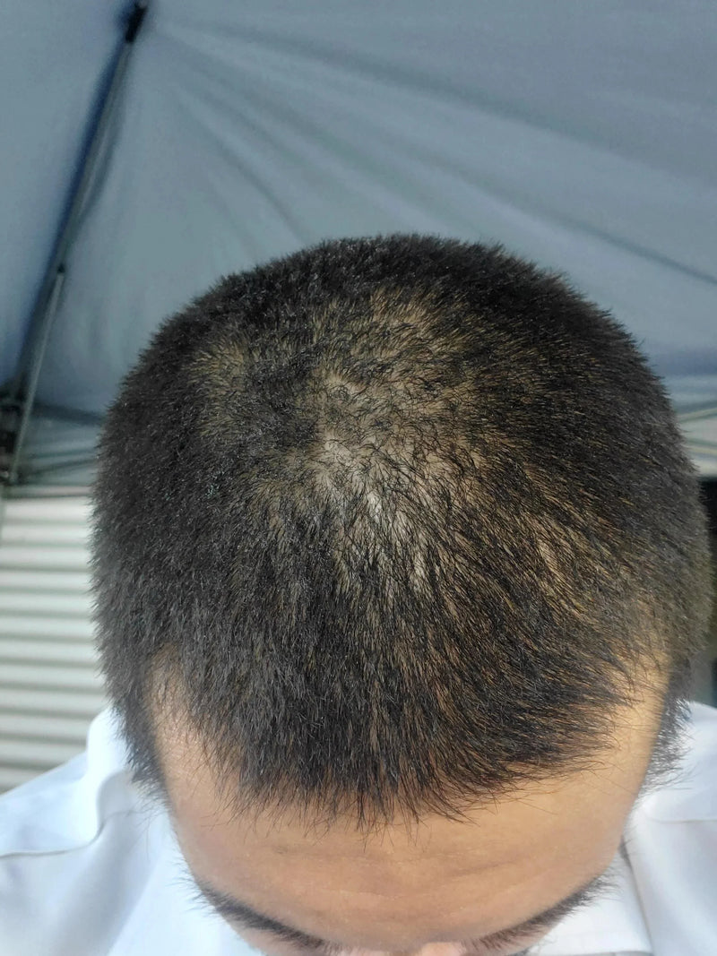 Kirkland Minoxidil 5% - Hairloss treatment - Hairdealz.com