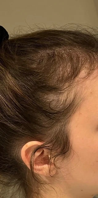 Kirkland Minoxidil 5% - Hairloss treatment - Hairdealz.com