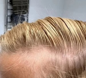 Prima — Kevin Mulder, Kirkland Minoxidil 5% per uomo, dopo 1 mese