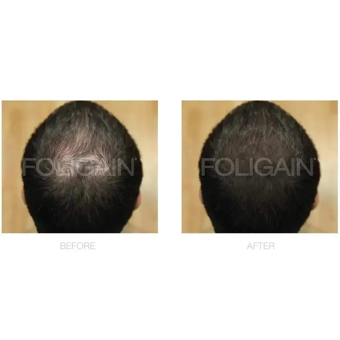 Foligain Lotion 5% for Men - Sensitive Skin (3-Month Supply)