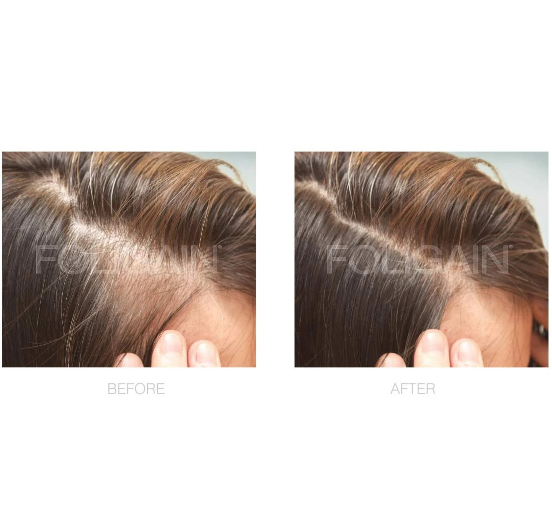 Foligain Minoxidil Lotion 2% for Women