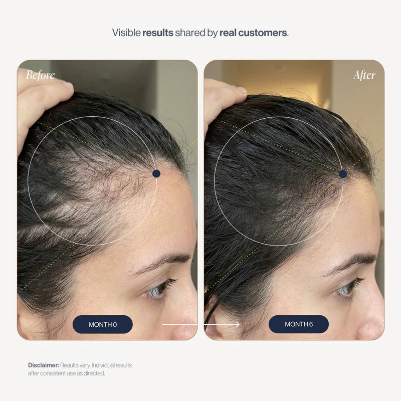 Growplex VitaFoam Minoxidil Foam 5%