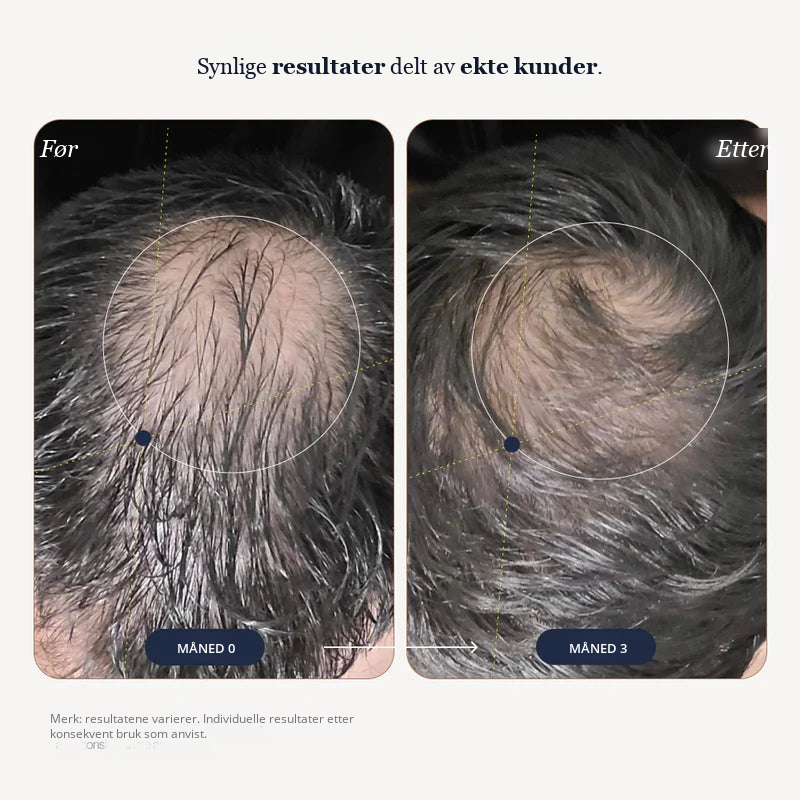 Growplex VitaFoam Minoxidil skum 5%
