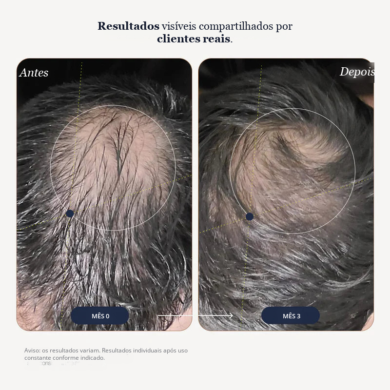 Espuma de Minoxidil Growplex VitaFoam 5%