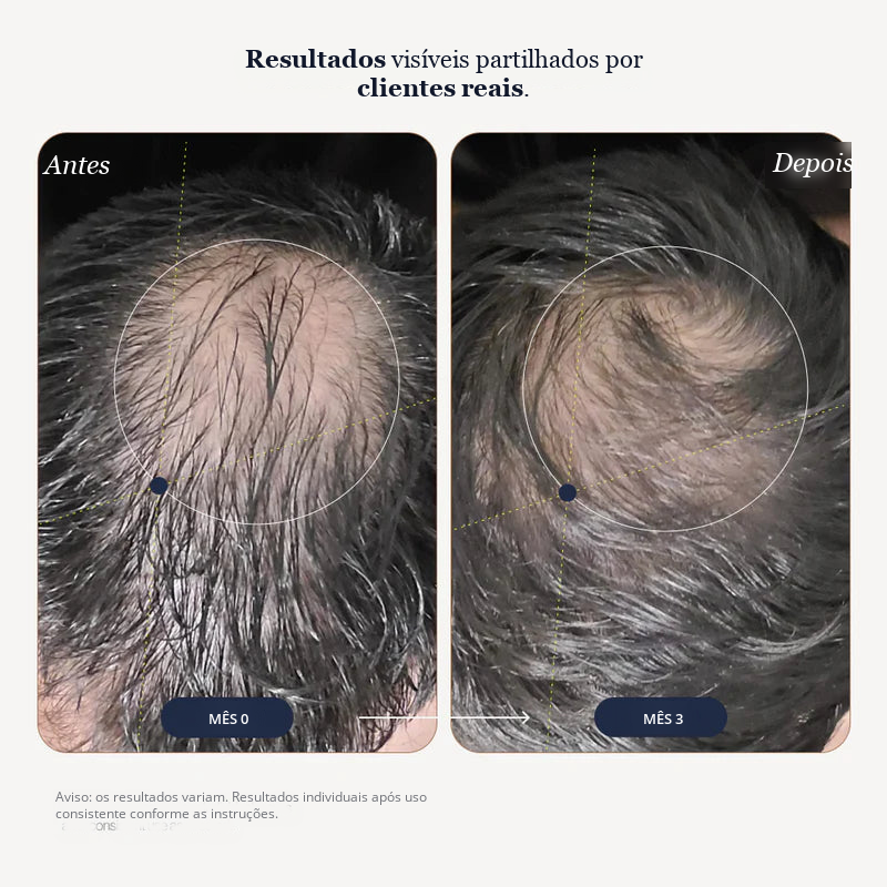 Growplex VitaFoam Minoxidil Foam 5%