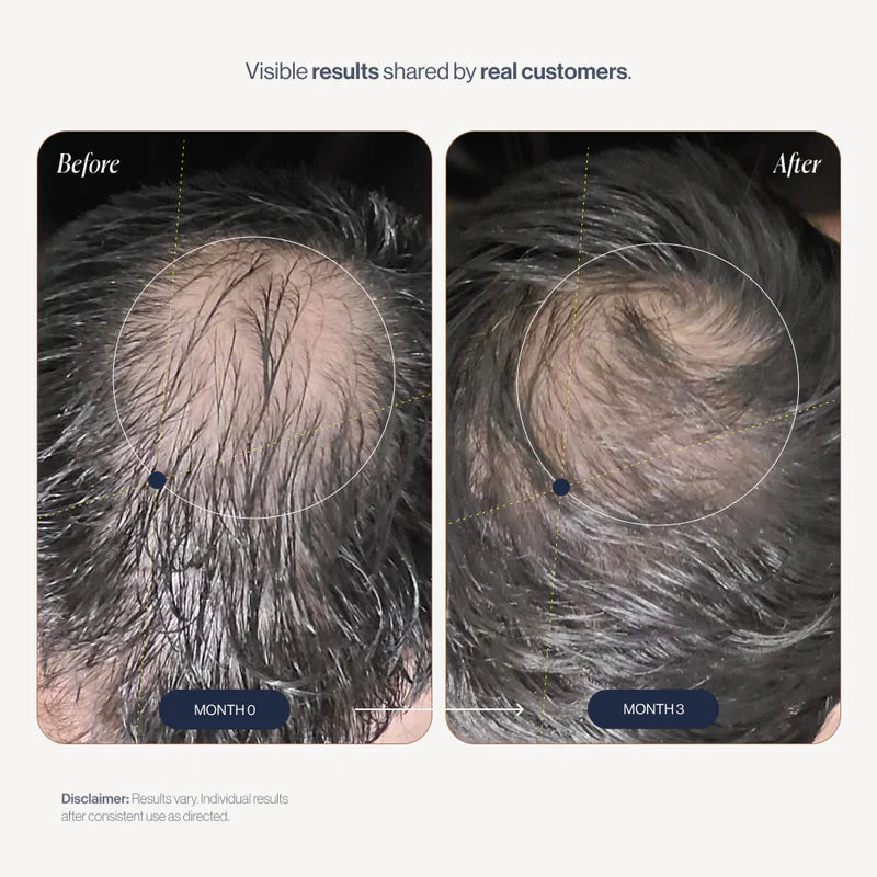 Growplex VitaFoam Minoxidil Foam 5%