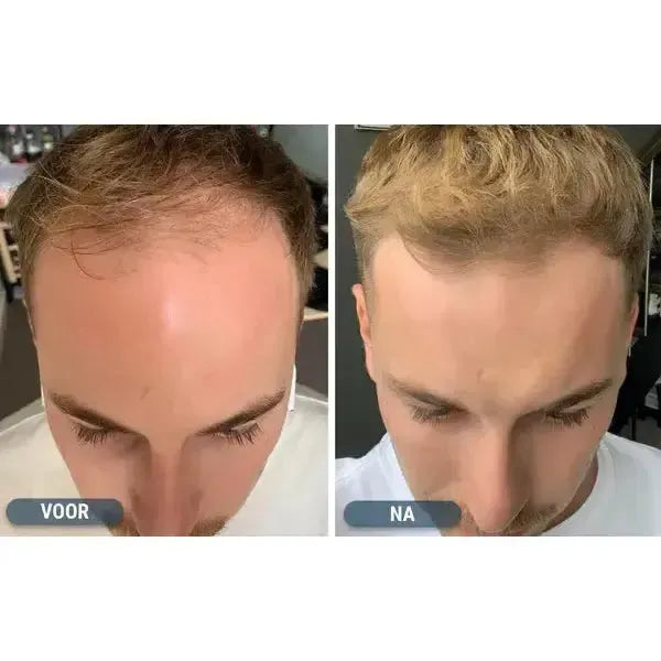 Kirkland Lotion 5% for Men (6-Month Supply)