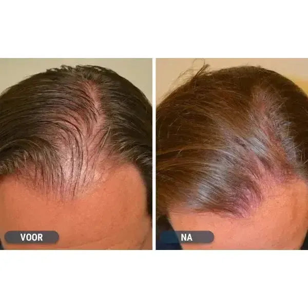 Kirkland Lotion 5% for Men (6-Month Supply)