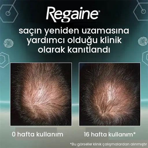 Regaine Minoksidil Köpük %5 Erkekler İçin - 12 Aylık Kullanım