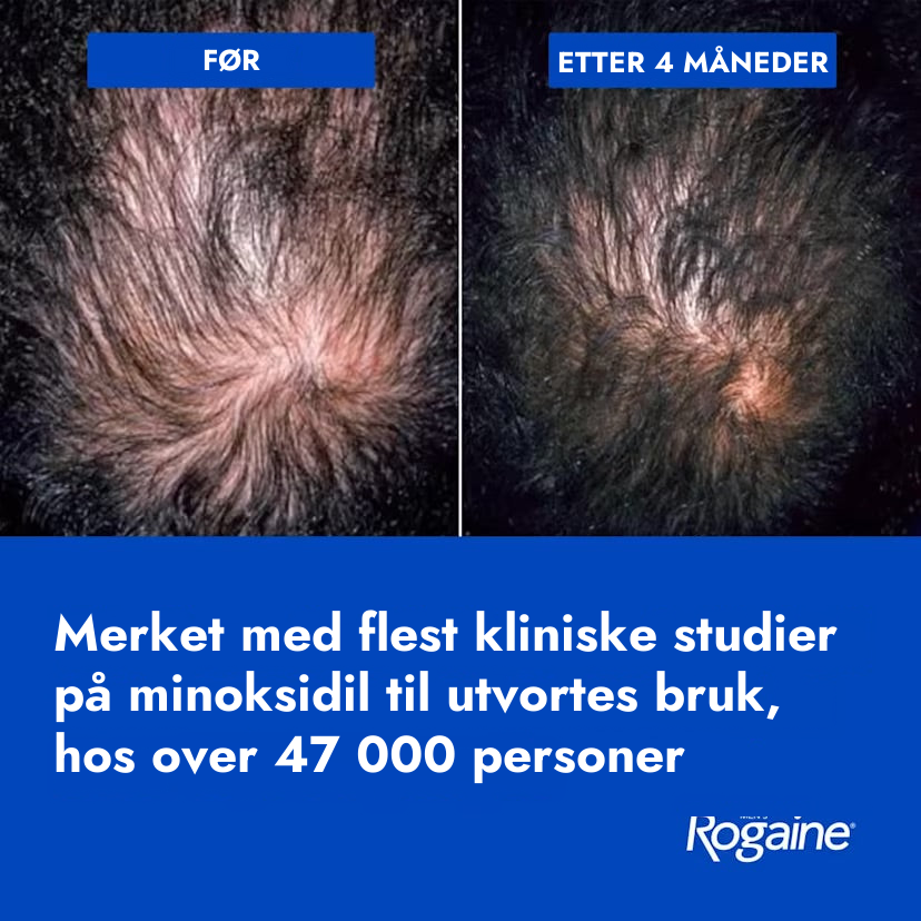 Rogaine Minoxidil skum 5% for menn
