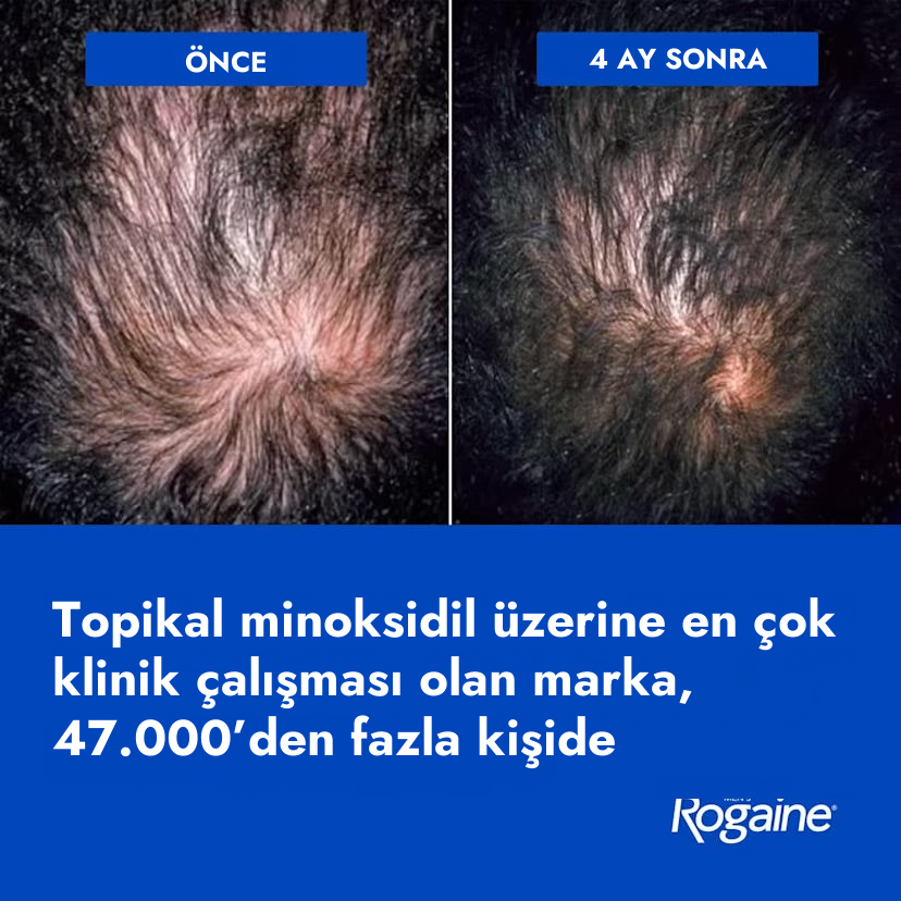 Rogaine Minoxidil Foam 5% for Men