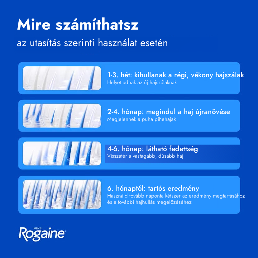 Rogaine Minoxidil 5% hab férfiaknak – mire számíthatsz