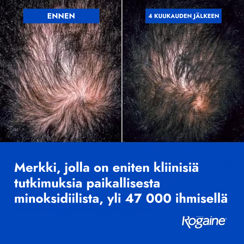 Rogaine Minoxidil Lotion 5% miehille