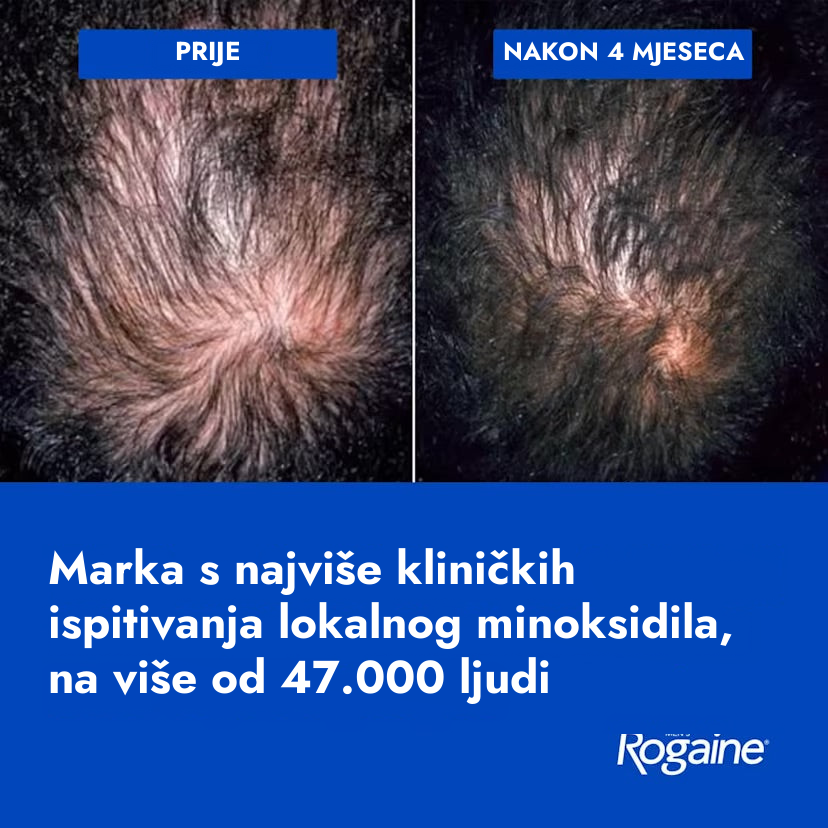 Rogaine minoksidil losion 5% za muškarce