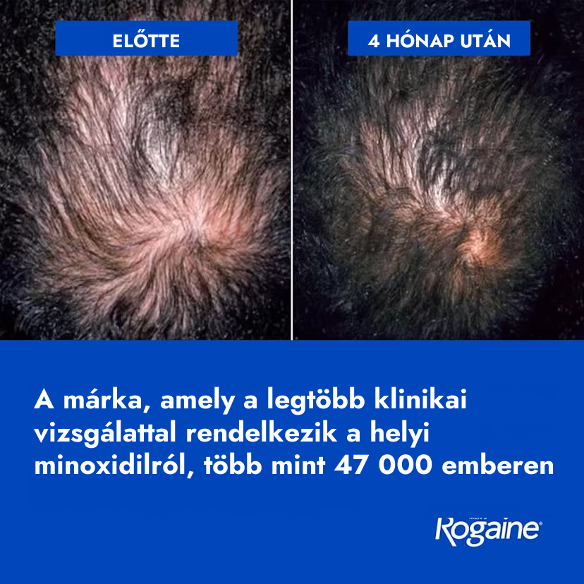 Rogaine minoxidil oldat 5% férfiaknak