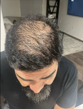 After: Jamie Wright, after switching to Kirkland minoxidil