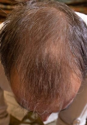 Kirkland Minoxidil 5% - Hairloss treatment - Hairdealz.com