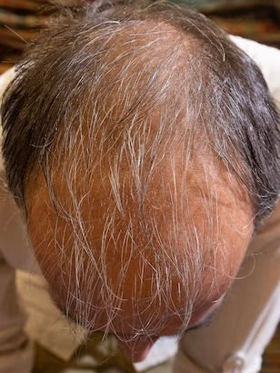 Kirkland Minoxidil 5% - Hairloss treatment - Hairdealz.com