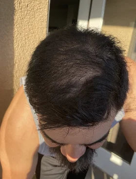 Before: Jamie Wright, after switching to Kirkland minoxidil