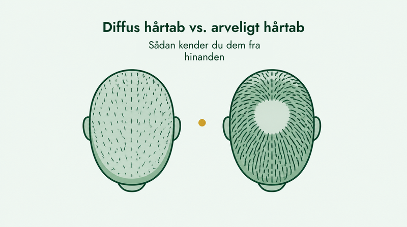Diffust hårtab versus arveligt hårtab