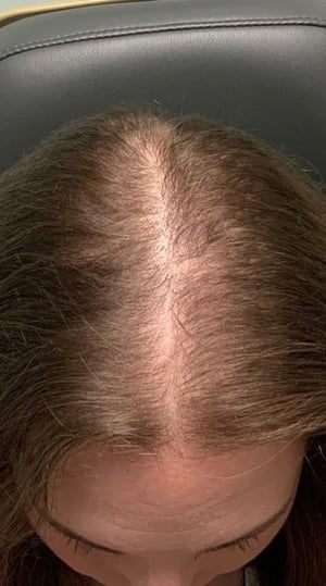 Kirkland Minoxidil 5% - Hairloss treatment - Hairdealz.com