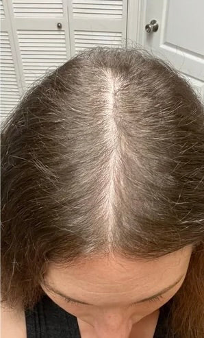 Kirkland Minoxidil 5% - Hairloss treatment - Hairdealz.com