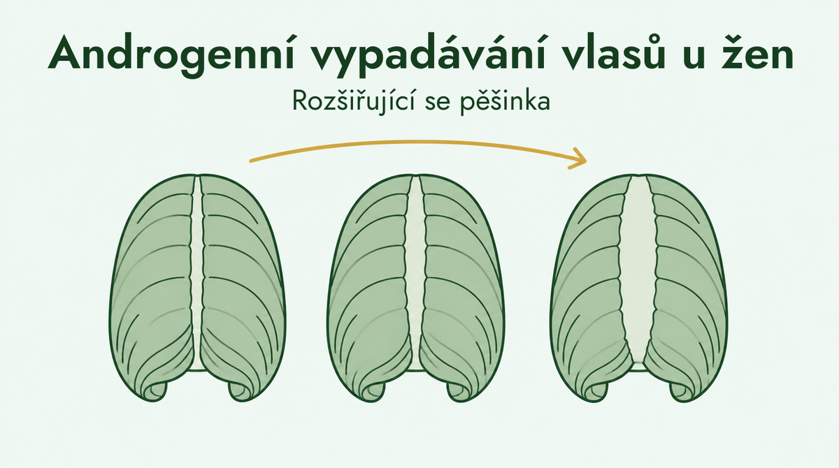 Ženské vypadávání vlasů a rozšiřující se pěšinka
