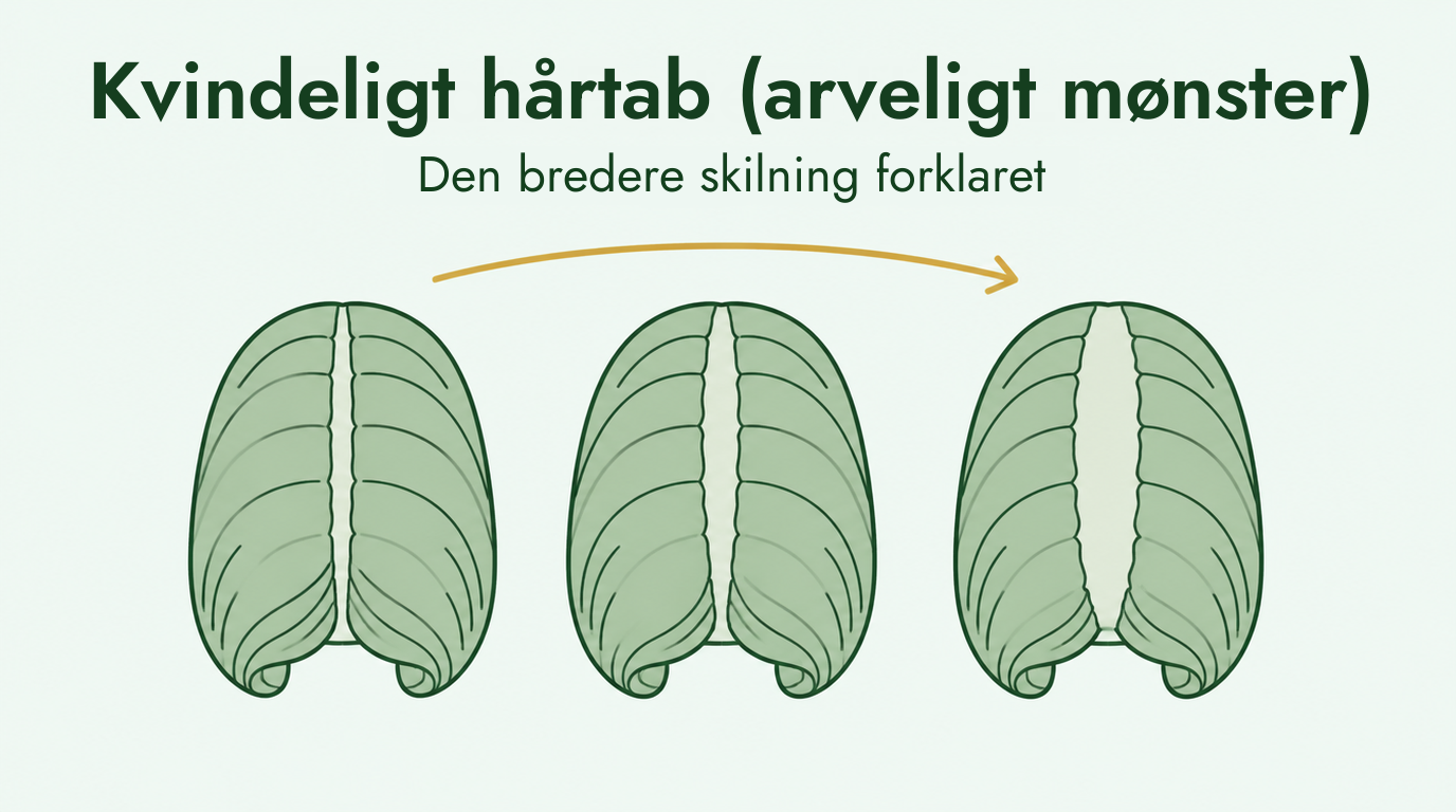 Hårtab hos kvinder og den bredere skilning