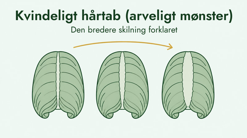 Hårtab hos kvinder og den bredere skilning