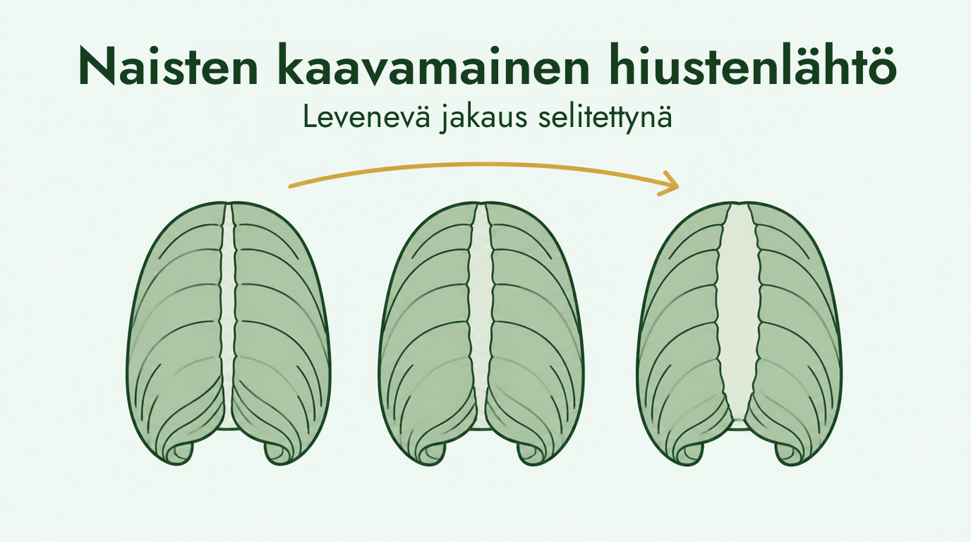 Naisten perinnöllinen hiustenlähtö ja levenevä jakaus