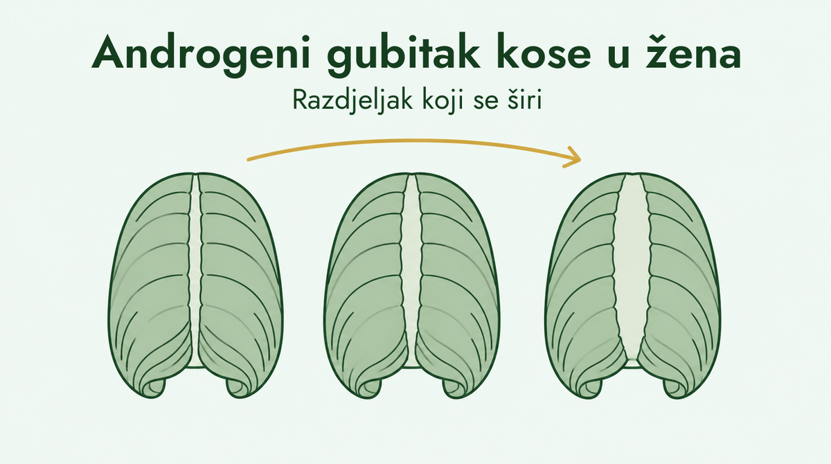 Ženski tip gubitka kose i sve šira razdjeljak