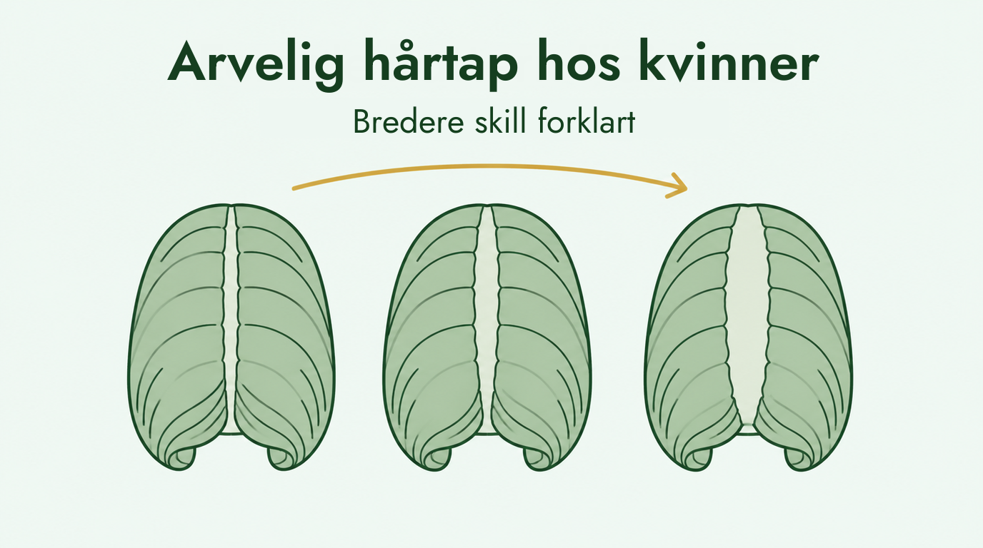 Kvinnelig mønsterbetinget hårtap og den bredere skillen