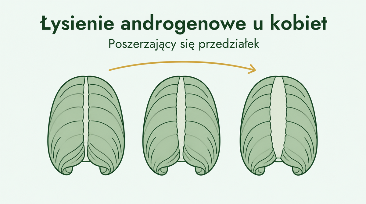 Kobiece łysienie androgenowe i poszerzający się przedziałek