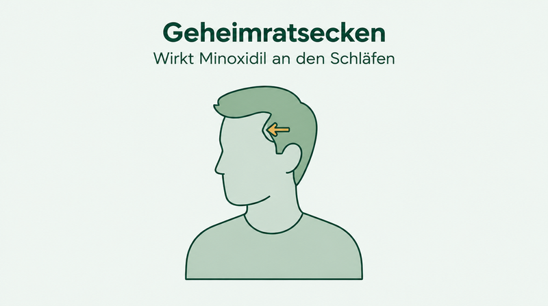 Wirkt Minoxidil bei zurückweichendem Haaransatz