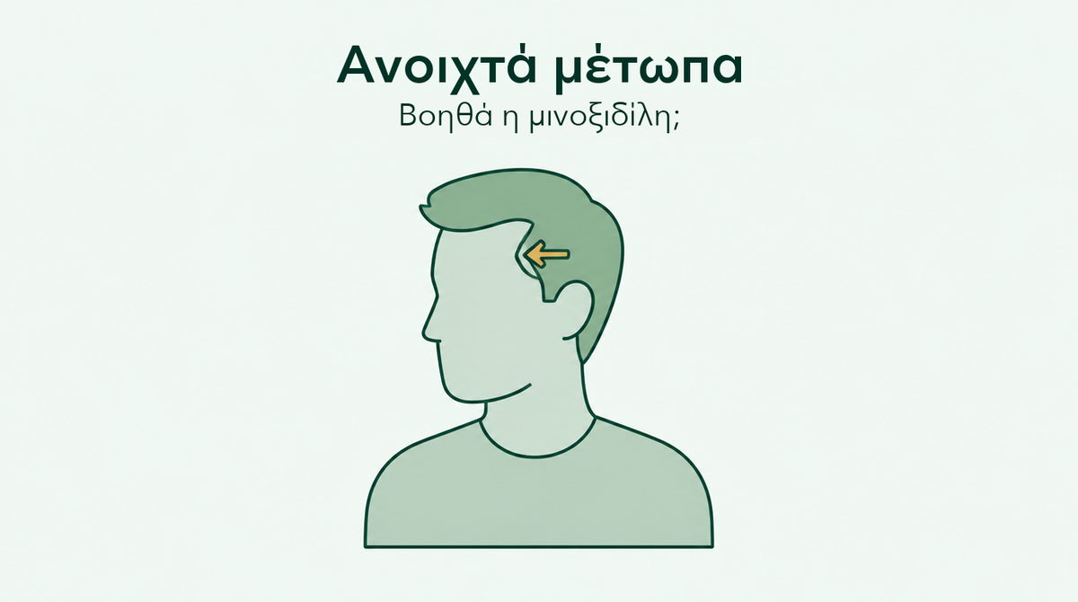 Λειτουργεί η μινοξιδίλη σε γραμμή των μαλλιών που υποχωρεί;