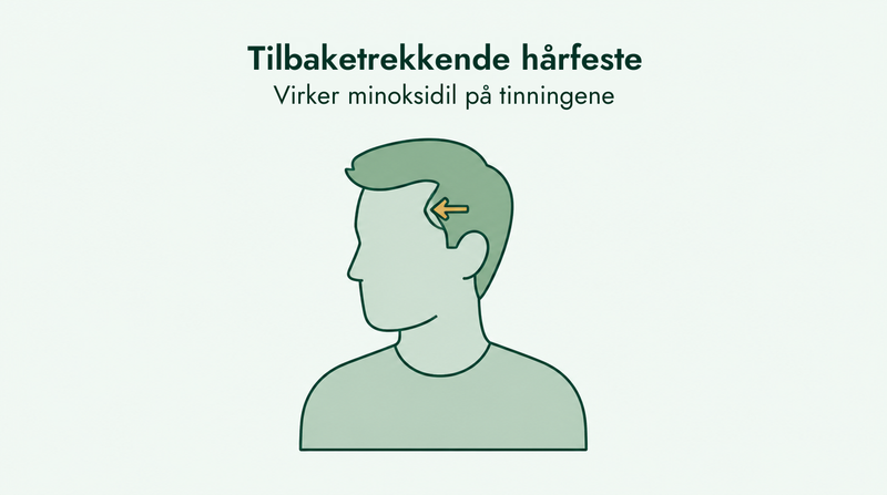 Virker minoksidil på et tilbaketrukket hårfeste