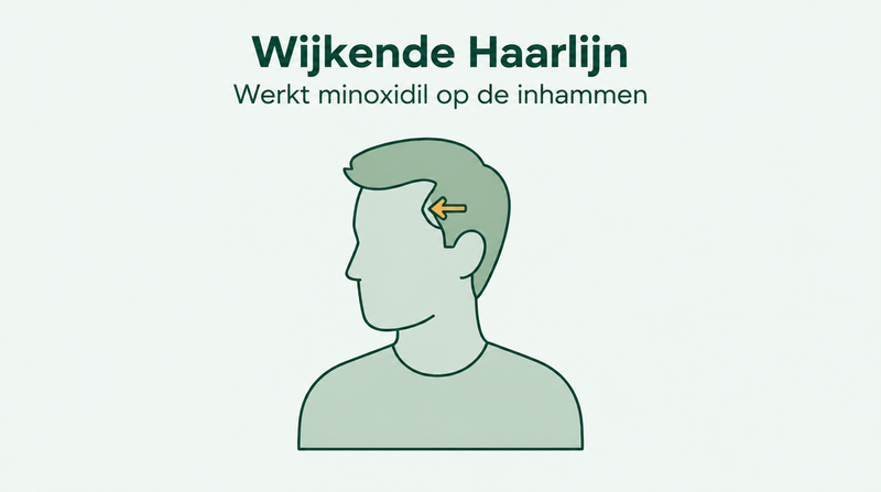 Werkt minoxidil bij een terugtrekkende haarlijn