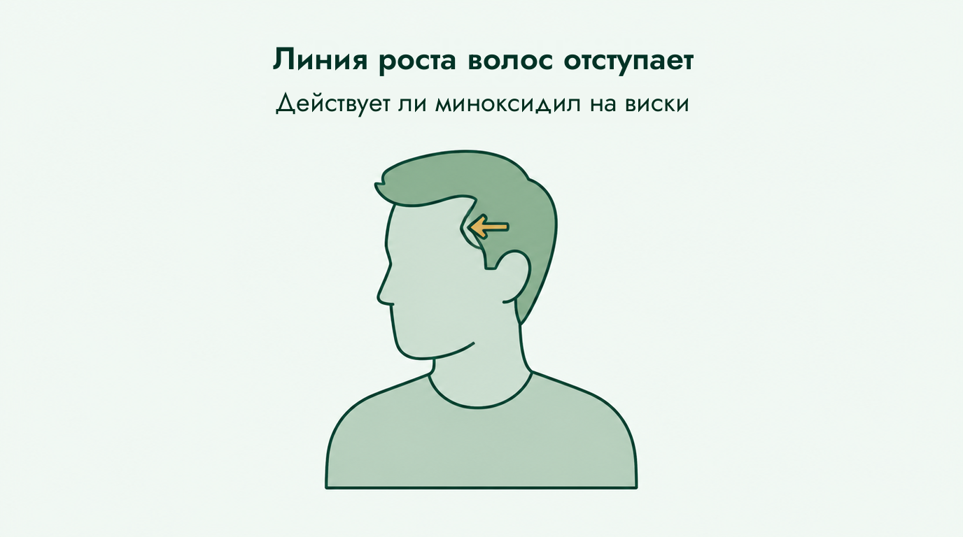 Работает ли миноксидил при залысинах на линии роста волос