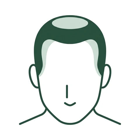 Illustration de cheveux qui s'affinent à la fois sur la ligne frontale et sur le vertex